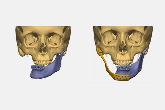 Two front views of a skull visualization. One with half of the jaw missing and other other with an implant replacing the missing jaw.