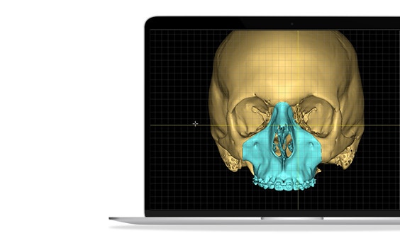 A 3D render of a human skull with a highlighted section in cyan on a laptop screen.