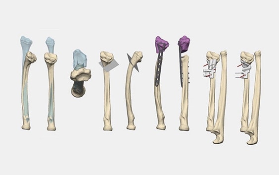 Various 3D renders of bones with 3D-printed surgical guides attached