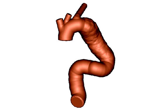 Computer rendering of a patient-based aortic model 
