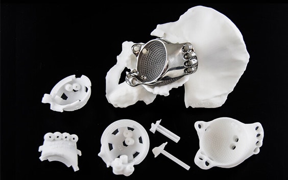 3D-printed implant in a hip model next to 3D-printed surgical guides