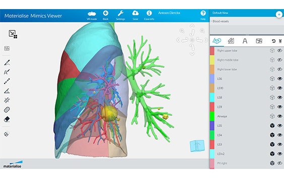 Screenshot of the Materialise Mimics Planner software showing a segmented 3D model of a patient's respiratory system