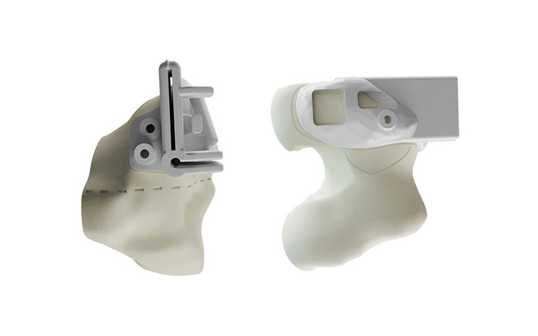 Two 3D-printed surgical guides on bone models