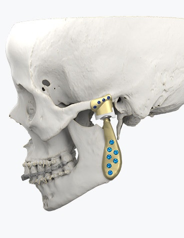 Digital render of a skull with a 3D-printed TMJ prosthesis