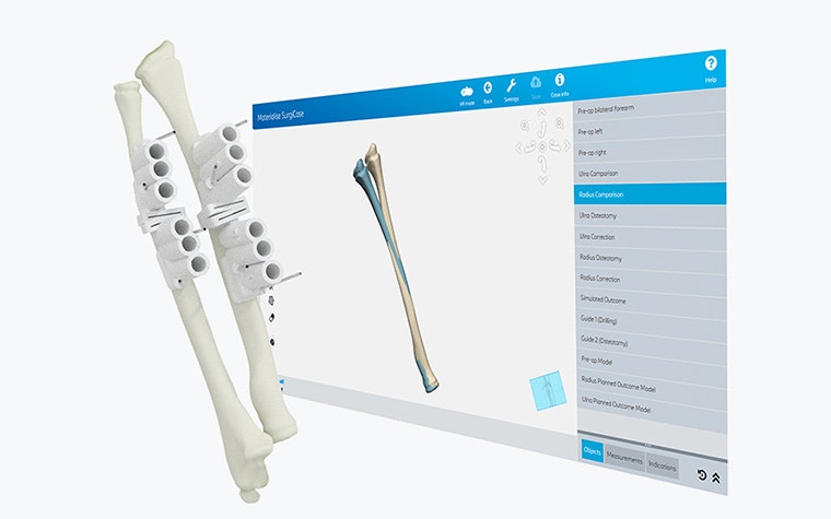 A digital image of two bones with personalized, 3D-printed surgical guides next to a Materialise Surgicase screen