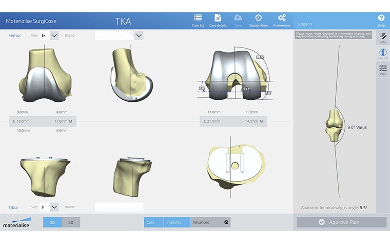 View of a TKA surgery plan on Surgicase