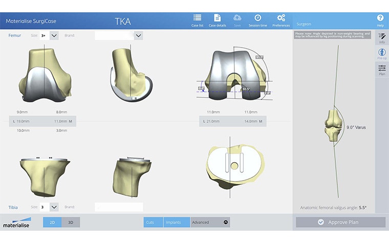 View of a TKA surgery plan on Surgicase 