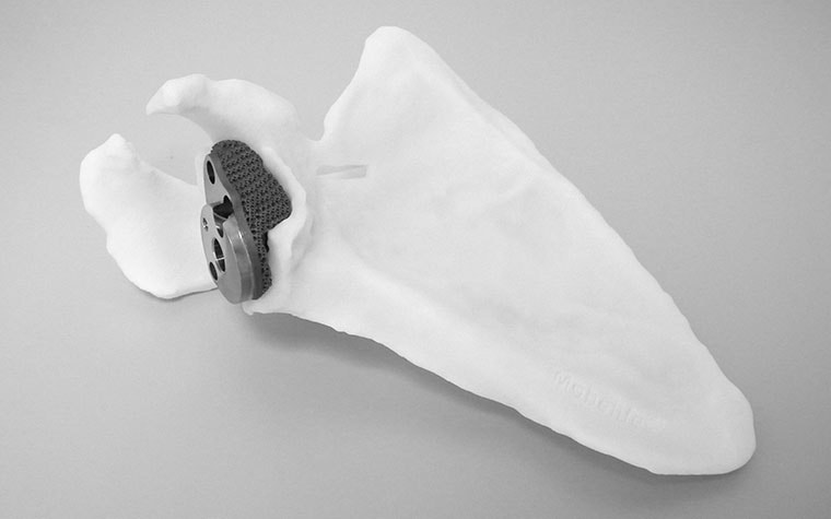 Personalized 3D-printed implant in a shoulder model