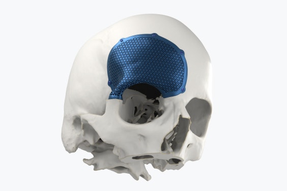Obere Hälfte eines Schädelmodells mit einem 3D-gedruckten MKG-Implantat