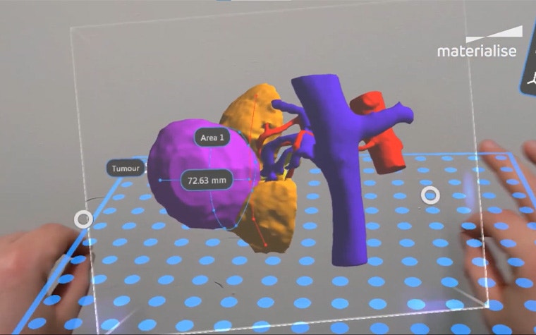 View of a patient's tumor with measurements through a augmented reality headset
