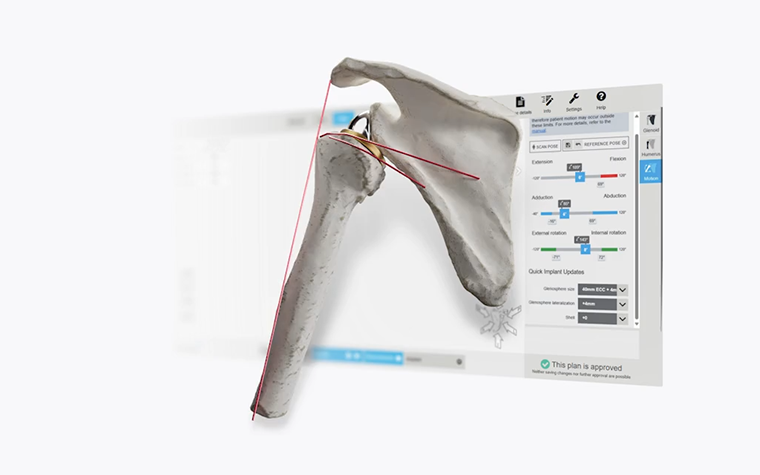Digital image of a shoulder bone with red measurement lines in front of a computer screen