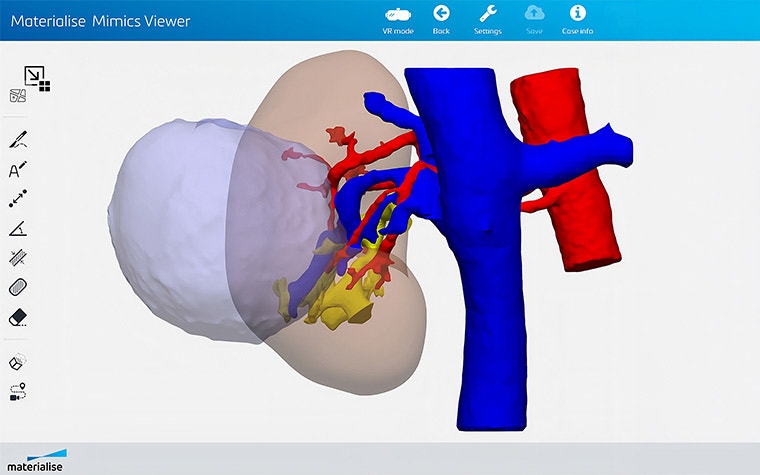 A screenshot from Materialise Mimics Viewer showing a 3D anatomical model with blood vessels in red and blue, and organ structures in translucent white and beige, used for medical visualization and analysis.