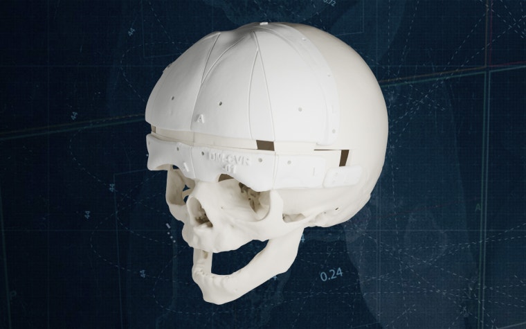 A 3D-printed anatomical model of an infant human skull with cranial cutting guides, displayed against a dark background.
