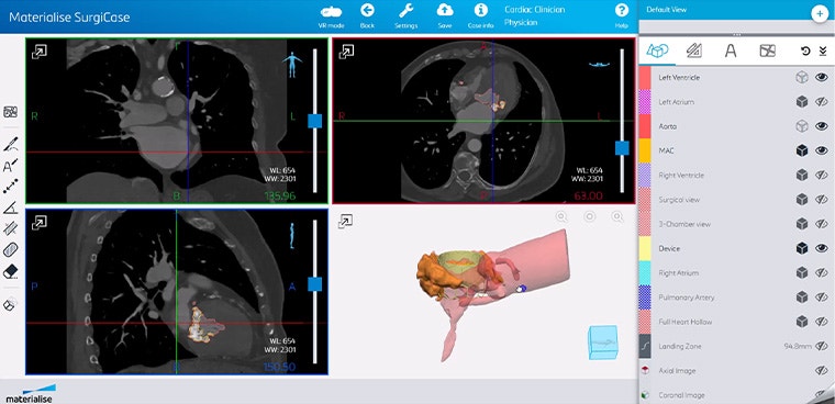 A screenshot showing various views of a patient's heart anatomy in Materialise SurgiCase software