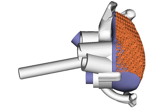 3D software image of shoulder guides for implant surgery 