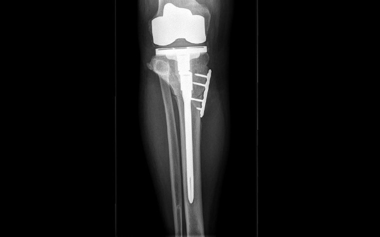 X-ray of patient's knee after the operation