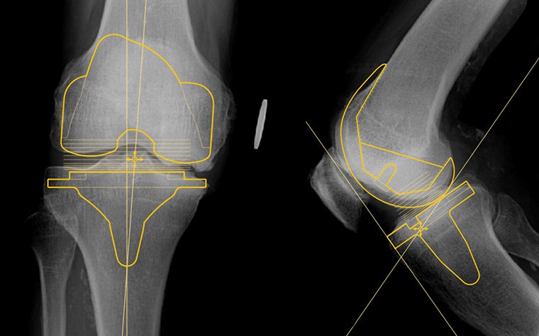 X-ray of a patient's knee with an overlay of a knee implant and measurements