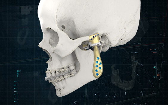 Side view of a skull model with personalized TMJ implants attached