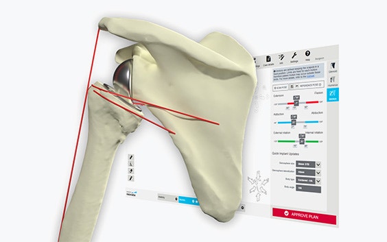 Digital image of a shoulder bone with red measurement lines in front of a computer screen