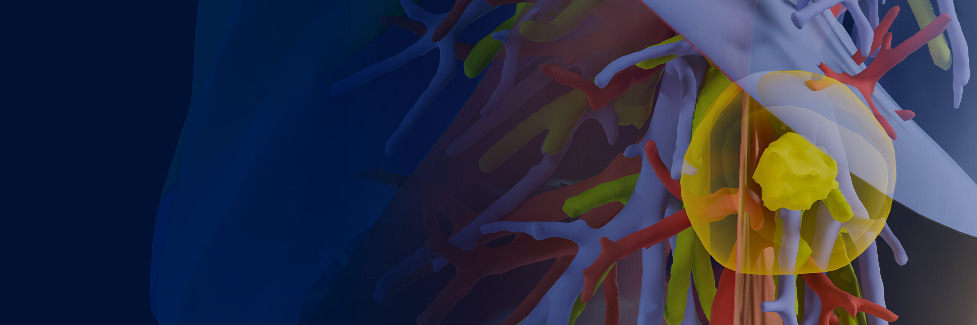 A 3D medical visualization of the upper chest area, showing semi-transparent anatomy with highlighted blood vessels and a yellow tumor in the lung.