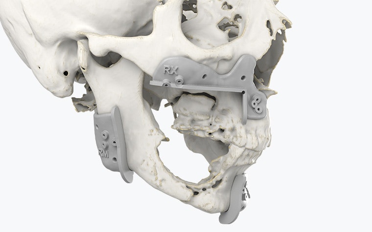 Vista lateral de un cráneo con guías quirúrgicas impresas en 3D colocadas alrededor de la mandíbula.