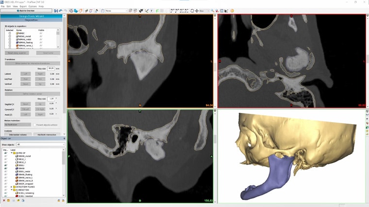 Screenshot showing the virtual planning of a CMF surgery with CMF ProPlan software