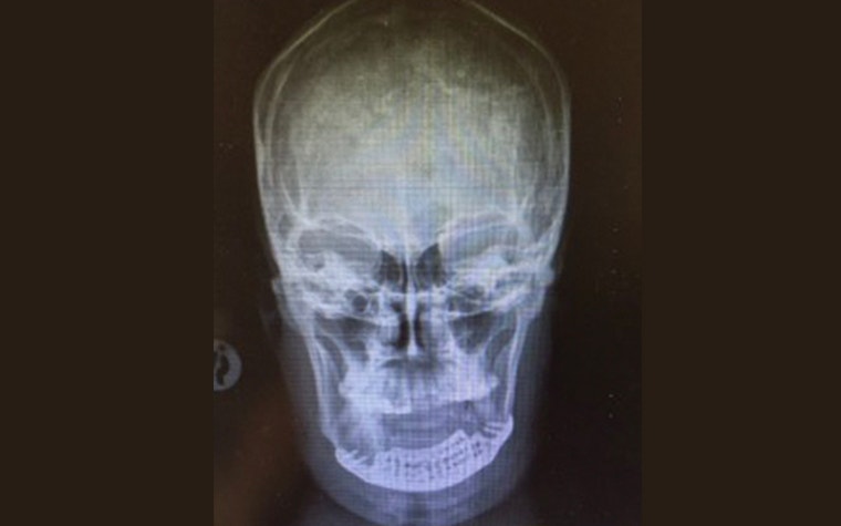 Scan of the patient's skull