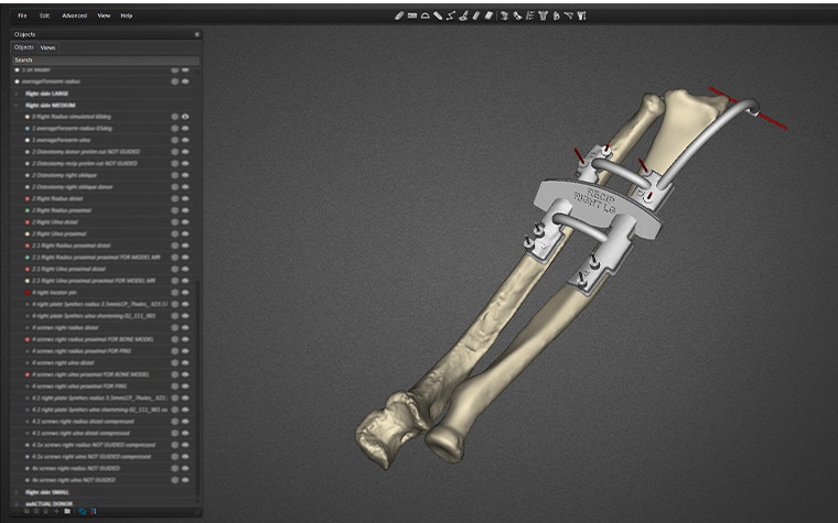 An on-screen 3D model based on a CT-scan