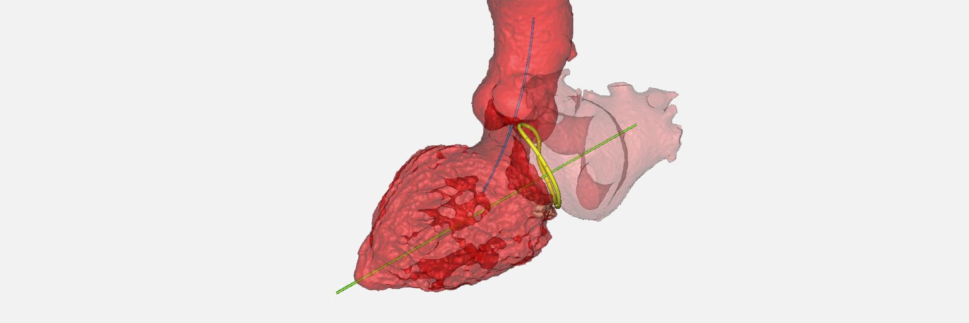 3D digital model of a heart with planning tools for surgery