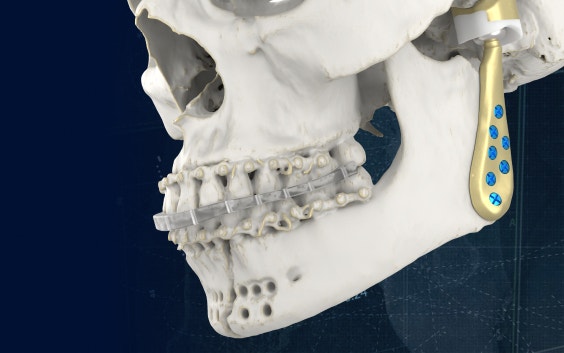 Side view of the bottom of a skull with personalized implants attached to the jaw
