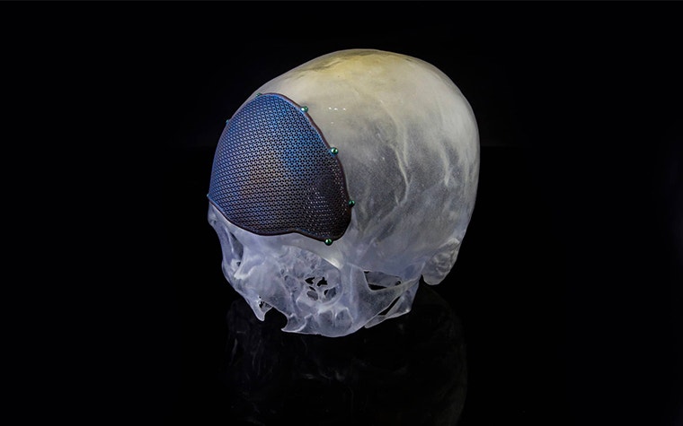 3D-printed skull model with a personalized 3D-printed cranial implant