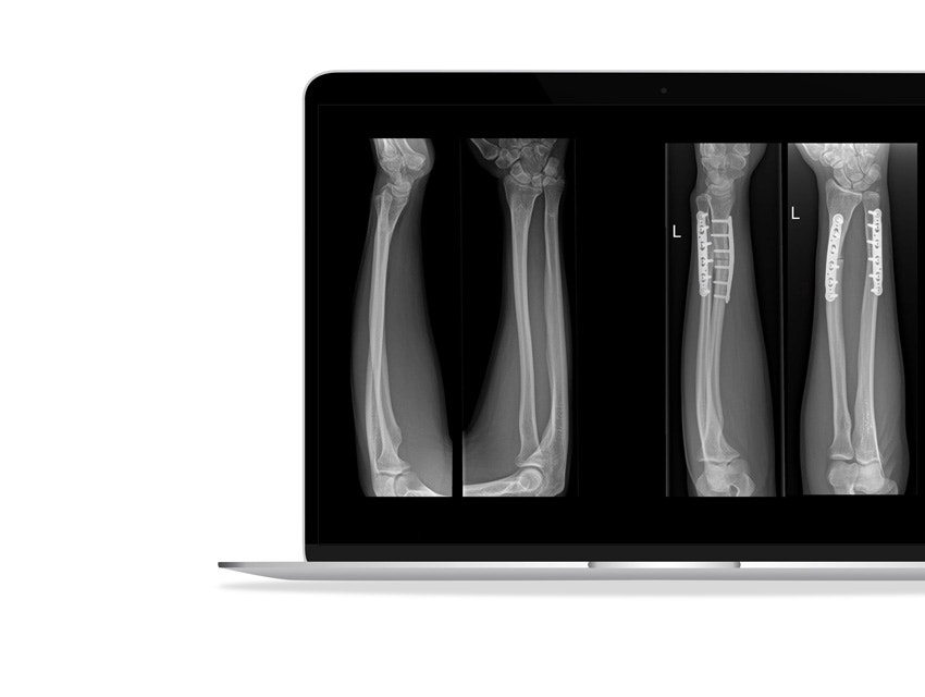 ssd-x-ray-forearms-3d-printed-guides.jpg