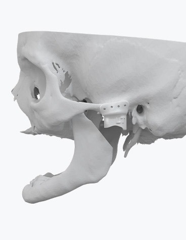 Digital render of a skull with a 3D-printed TMJ implant