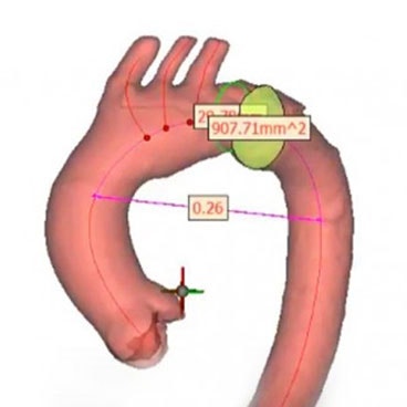 How to Analyze the Centerline of the Aorta 