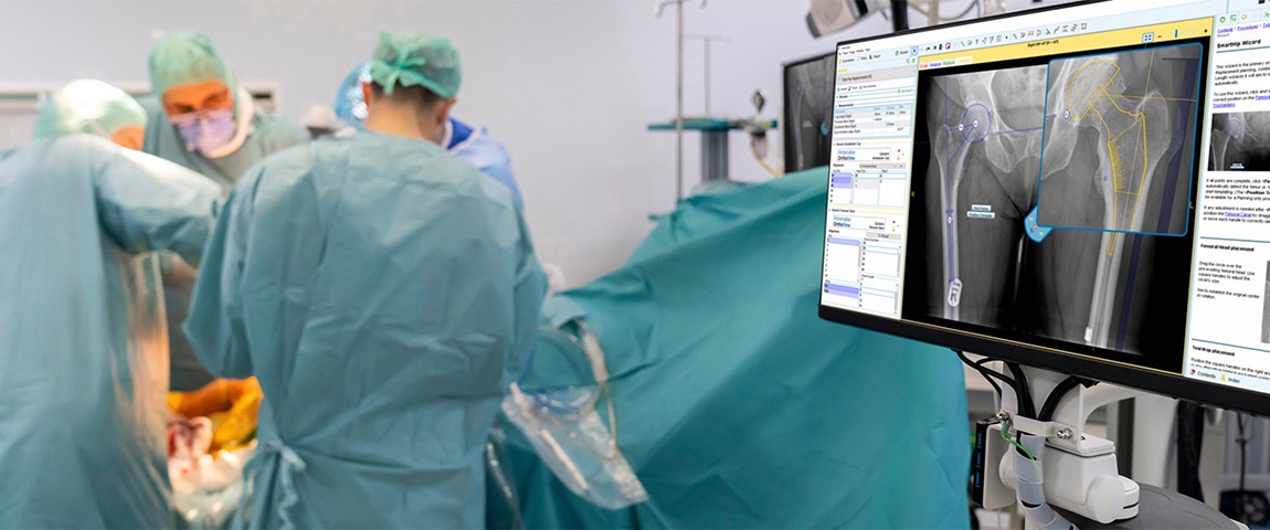 Four people in surgical gear operating on a patient with a computer screen open of a hip implant operating plan.
