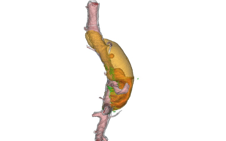 Materialise Mimics-based 3D reconstruction of a dissecting aneurysm 