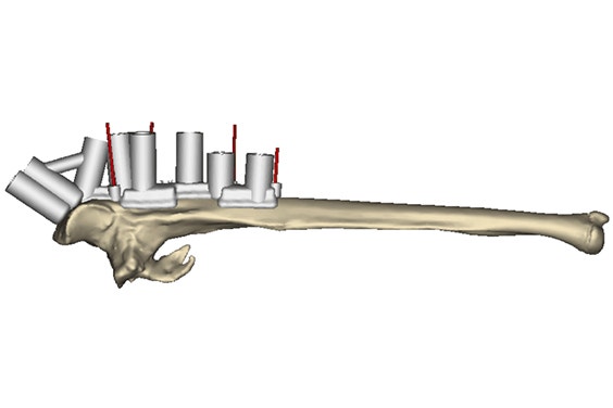 Digital image of surgical guides on a bone 