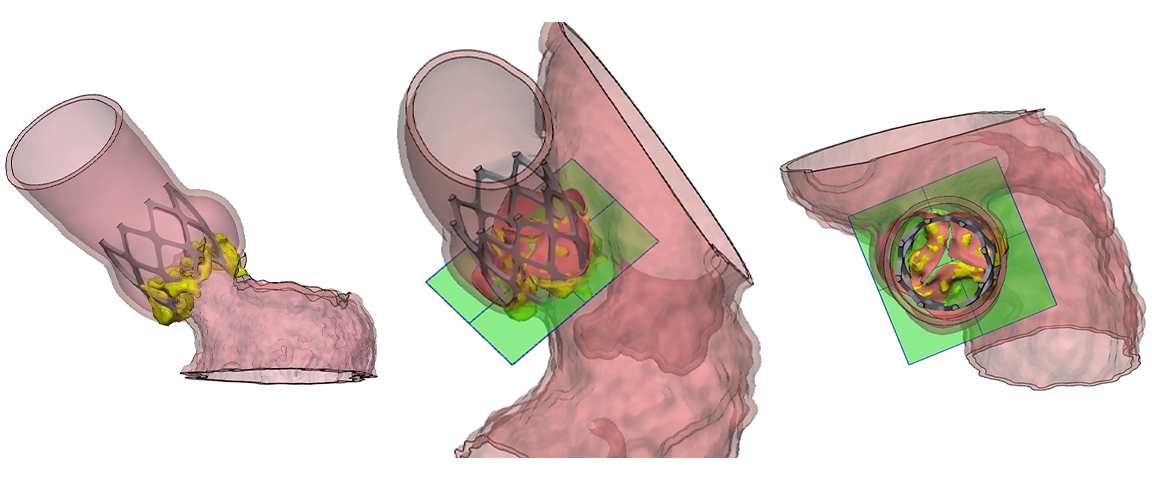 An example 3D left heart model was created from a contrasted CT scan, allowing clear visualization of the aortic valve and precise device planning based on patient-specific anatomy.