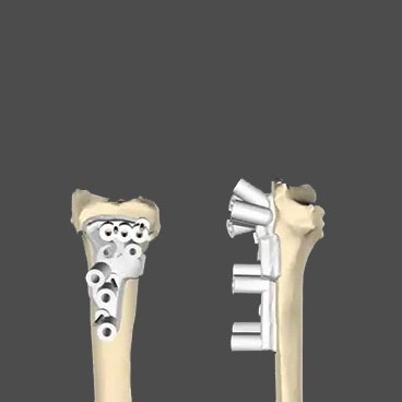 Corrective Osteotomies for Malunion of the Wrist and Forearm Using 3D Computer Planning and Patient-Specific Instruments