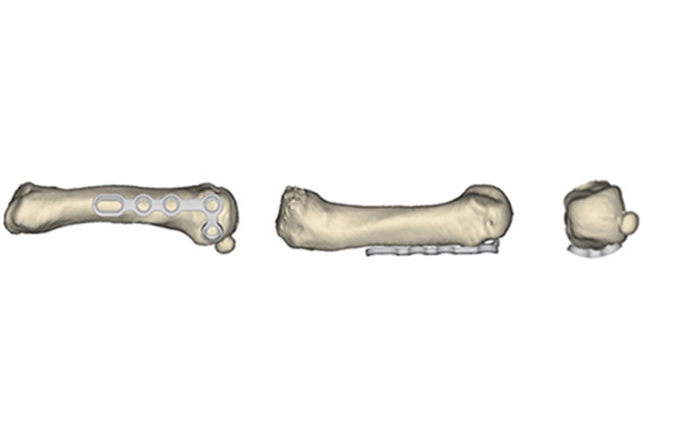 Old metacarpal plate design 