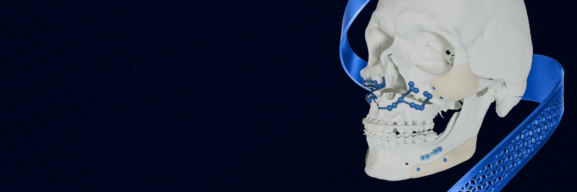 A model of a skull with 3D-printed titanium plates on a blue background.