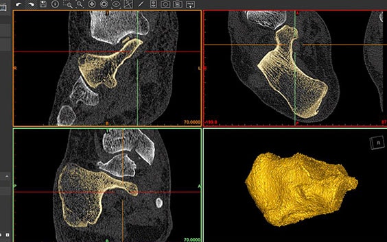 Screenshot of 4 images, showing how to use the bone filling tool