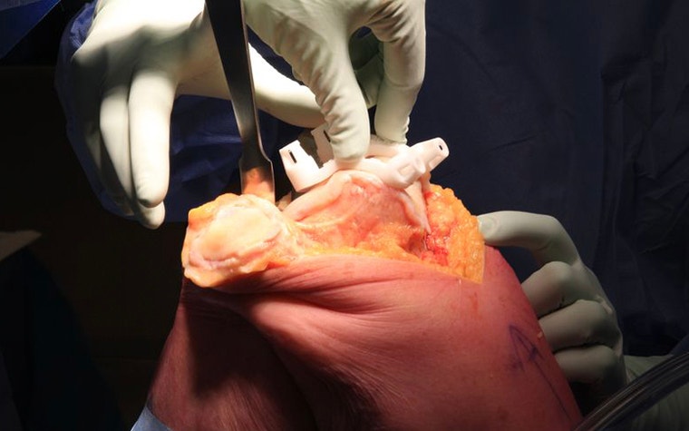 An orthopaedic surgeon performin a total knee arthroplasty using 3D-printed guides 
