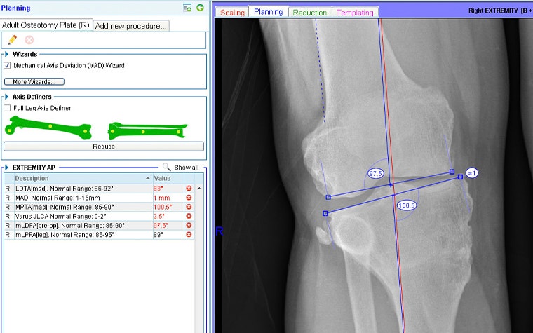 OrthoView showing surgical planning for a total knee replacement