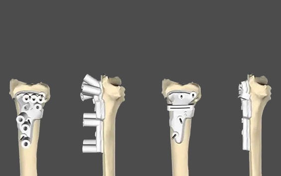 Corrective Osteotomies for Malunion of the Wrist and Forearm, using 3D Computer Planning and Patient-Specific Instruments