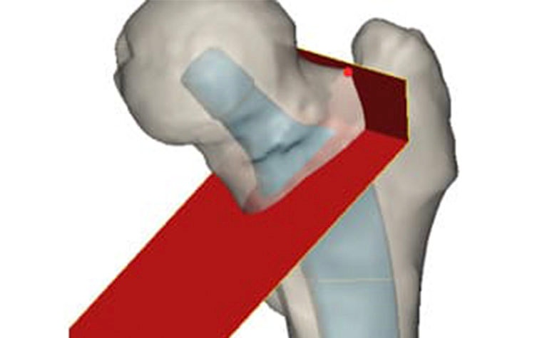 Digital image of a bone with a virtual osteotomy cut