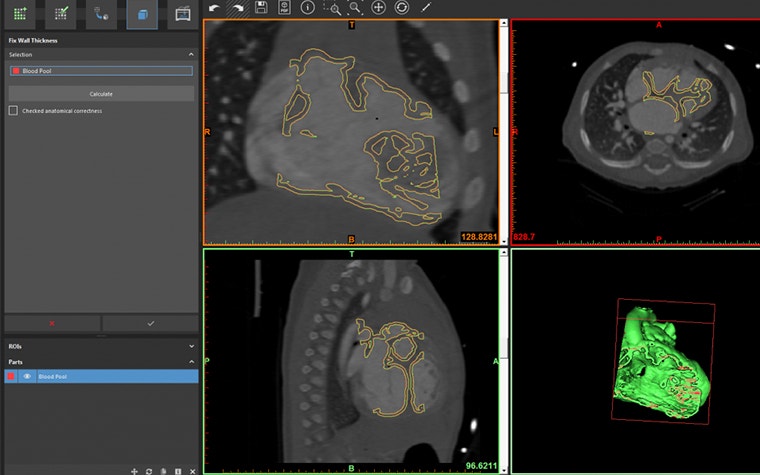 Screenshot of wall thickness tool in use in medical 3D printing software 