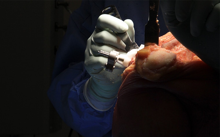 A knee joint exposed during a total knee replacement surgery