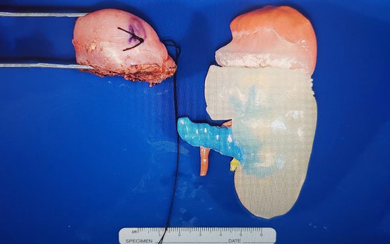 3D-Modell einer Kinderniere neben einem entfernten Schnitt derselben Kinderniere