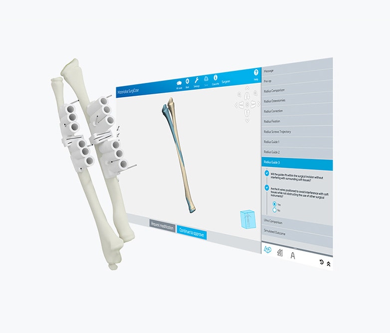 Two bone models with 3D-printed, personalized surgical guides attached in front of a screen showing patient anatomy in Materialise SurgiCase